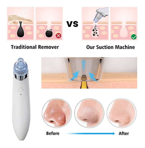4 in 1 Blackhead Removal Machine - Nooraxo